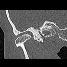 File:Adhesive chronic otitis media (Radiopaedia 14270-14148 Coronal bone window - right 2).jpg