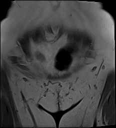 File:Adnexal multilocular cyst (O-RADS US 3- O-RADS MRI 3) (Radiopaedia 87426-103754 Sagittal T2 26).jpg