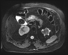 File:Adrenal cortical carcinoma (Radiopaedia 64017-72770 Axial DWI 16).jpg