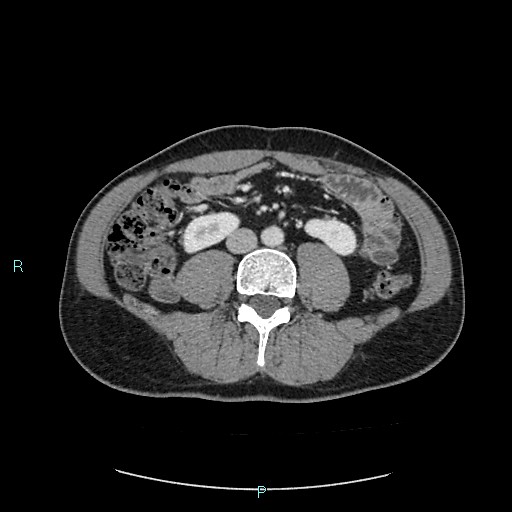 Adrenal cystic lymphangioma (Radiopaedia 83161-97534 Axial C+ portal venous phase 57).jpg