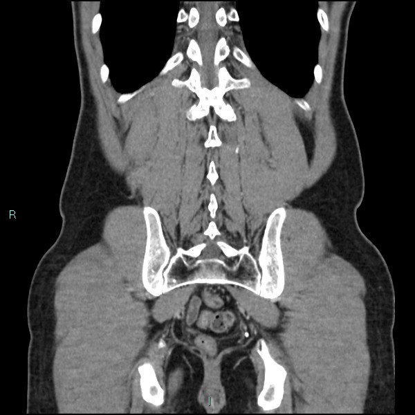 Adrenal cystic lymphangioma (Radiopaedia 83161-97534 Coronal C+ portal venous phase 62).jpg