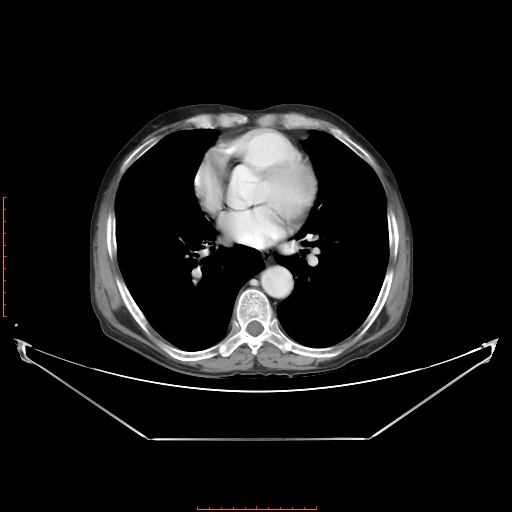 Adrenal hemangioma (Radiopaedia 68923-78668 Axial C+ portal venous phase 2).jpg