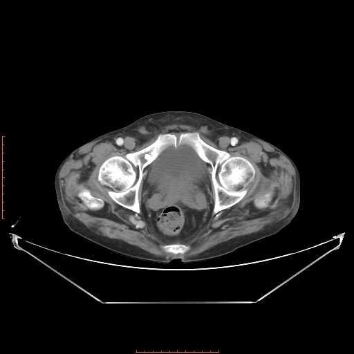 Adrenal hemangioma (Radiopaedia 68923-78668 Axial C+ portal venous phase 67).jpg
