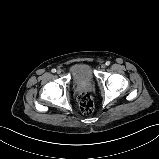 Adrenal lymphoma (Radiopaedia 73730-84529 Axial C+ portal venous phase 121).jpg