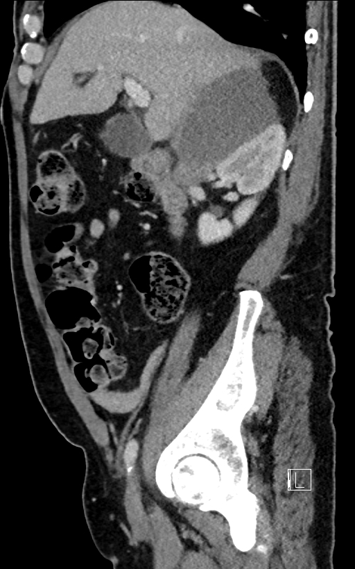 Adrenal lymphoma (Radiopaedia 73730-84529 Sagittal C+ portal venous phase 38).jpg