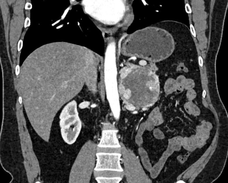 File:Adrenal metastases (Radiopaedia 73082-83791 Coronal C+ arterial phase 30).jpg