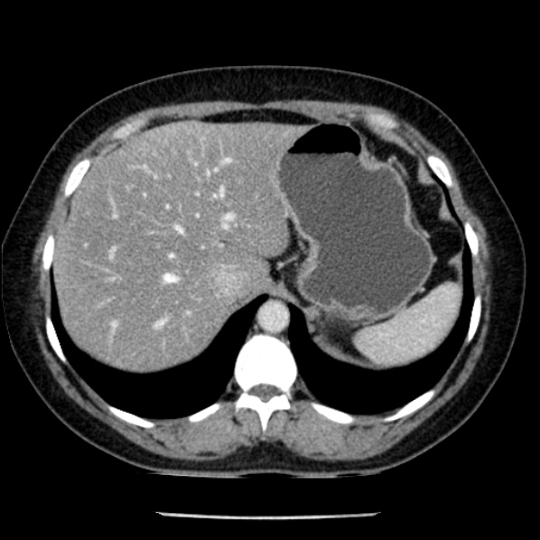 Adrenal myelolipoma (Radiopaedia 43401-46759 Axial C+ portal venous phase 15).jpg