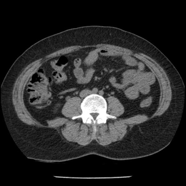 Adrenal myelolipoma (Radiopaedia 43401-46759 Axial non-contrast 50).jpg