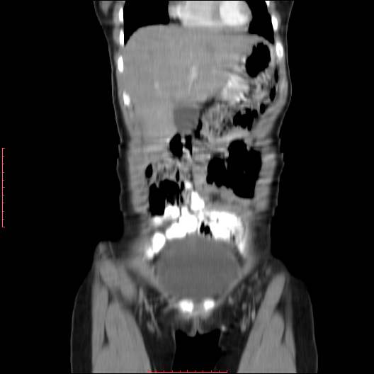 File:Adrenal vein sampling and adrenal nodular hyperplasia - Conn syndrome (Radiopaedia 30561-31337 Axial non-contrast 23).jpg