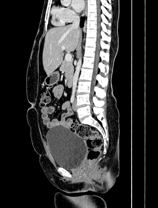 Adrenocortical carcinoma (Radiopaedia 87281-103569 Sagittal C+ portal venous phase 147).jpg