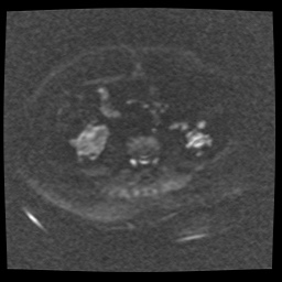 Adult polycystic kidney disease (Radiopaedia 59075-66365 Axial DWI 37).jpg