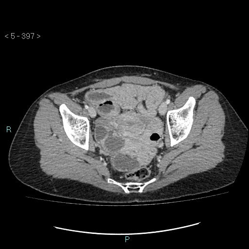Adult transient intestinal intussusception (Radiopaedia 34853-36310 Axial C+ portal venous phase 102).jpg