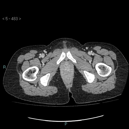 File:Adult transient intestinal intussusception (Radiopaedia 34853-36310 Axial C+ portal venous phase 132).jpg