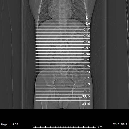 Agenesis of the gallbladder (Radiopaedia 55454-61905 B 1).jpg
