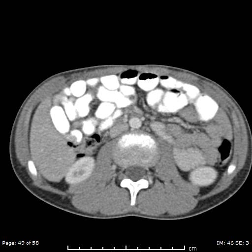 Agenesis of the gallbladder (Radiopaedia 55454-61905 B 49).jpg