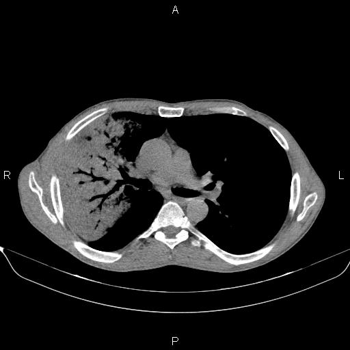 Air bronchogram in pneumonia (Radiopaedia 85719-101512 Axial non-contrast 30).jpg