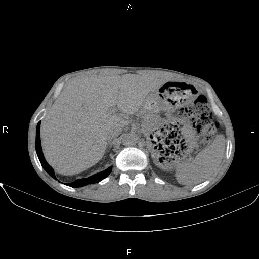 Air bronchogram in pneumonia (Radiopaedia 85719-101512 Axial non-contrast 68).jpg