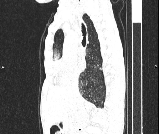 Air bronchogram in pneumonia (Radiopaedia 85719-101512 Sagittal lung window 44).jpg