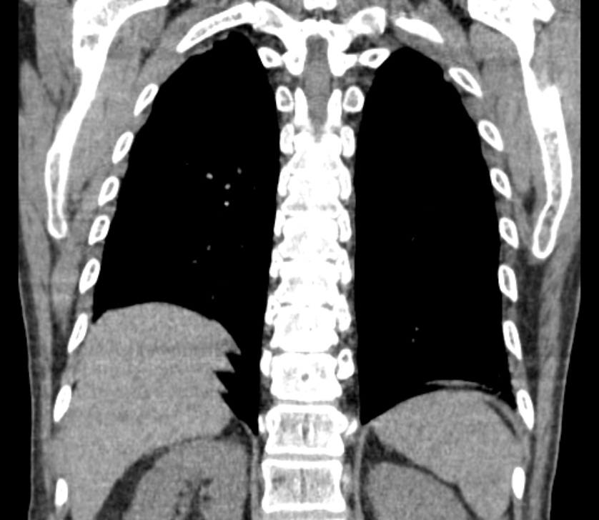 Airway foreign body in adult (Radiopaedia 85907-101779 Coronal liver window 214).jpg
