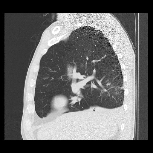 Allergic bronchopulmonary aspergillosis (ABPA) (Radiopaedia 60594-68313 Sagittal lung window 40).jpg