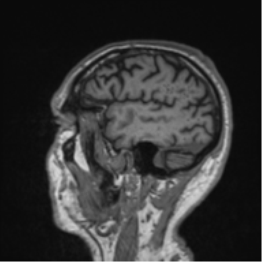 Alzheimer's disease- with Gerstmann syndrome and dressing apraxia (Radiopaedia 54882-61150 Sagittal T1 11).png