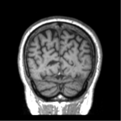 Alzheimer disease and cerebral amyloid angiopathy (Radiopaedia 64234-73011 Coronal T1 2).png