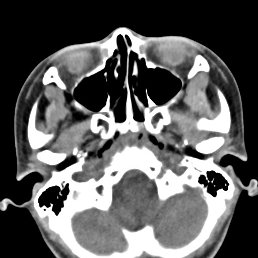 File:Ameloblastoma (Radiopaedia 26645-26793 Axial C+ delayed 35).jpg