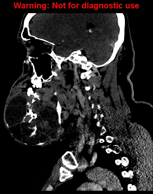 Ameloblastoma (Radiopaedia 33126-34164 F 28).jpg