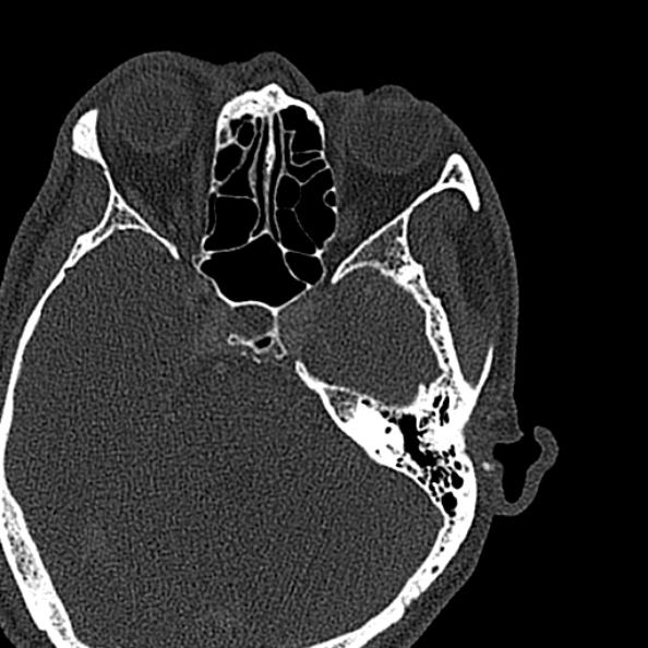 Ameloblastoma (Radiopaedia 51921-57766 Axial bone window 172).jpg