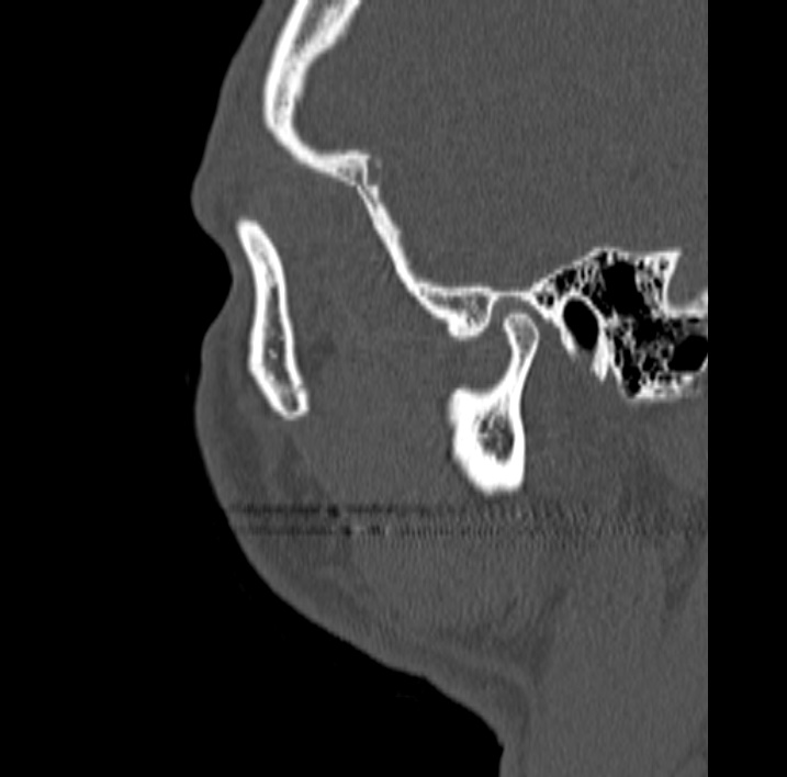 Ameloblastoma (Radiopaedia 77750-89997 Sagittal bone window 117).jpg