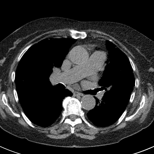 File:Amiodarone-induced pulmonary fibrosis (Radiopaedia 82355-96460 Axial non-contrast 31).jpg