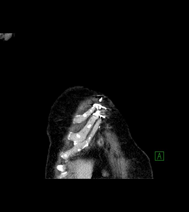 Amiodarone deposition in the liver (Radiopaedia 77587-89780 Coronal non-contrast 10).jpg