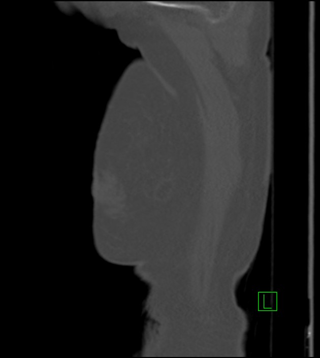 Amiodarone deposition in the liver (Radiopaedia 77587-89780 Sagittal bone window 96).jpg