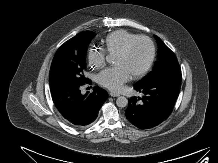 Amiodarone lung (Radiopaedia 62514-70769 Axial non-contrast 51).jpg
