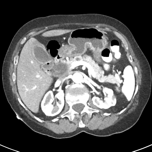 Ampullary adenocarcinoma (Radiopaedia 34013-35237 B 30).png