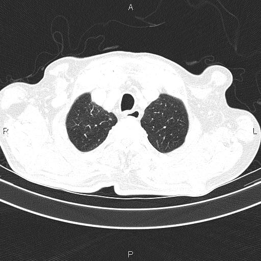 File:Ampullary adenocarcinoma (Radiopaedia 86093-102033 Axial lung window 17).jpg