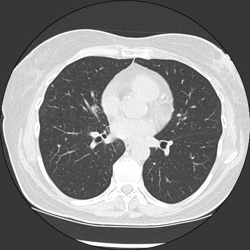 File:Amyloidosis - bronchial and diffuse nodular pulmonary involvement (Radiopaedia 60156-67744 B 32).jpg