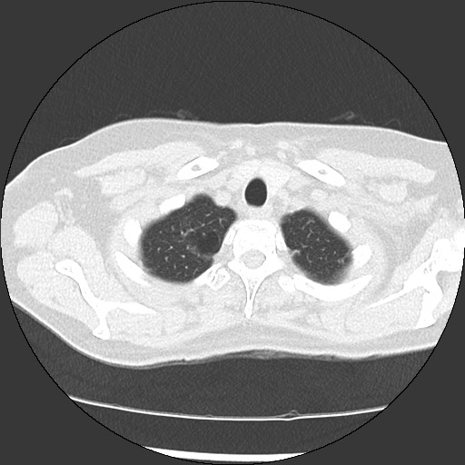 Amyloidosis - bronchial and diffuse nodular pulmonary involvement (Radiopaedia 60156-67744 B 7).jpg