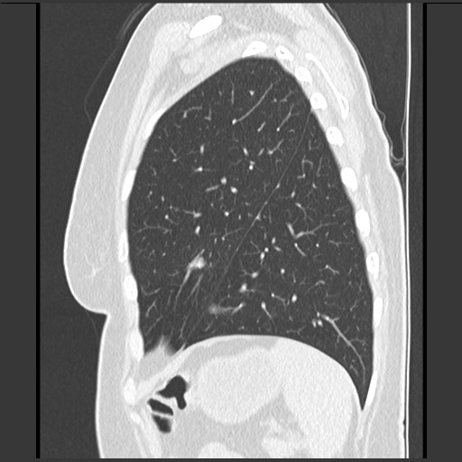 Amyloidosis - bronchial and diffuse nodular pulmonary involvement (Radiopaedia 60156-67744 F 45).jpg