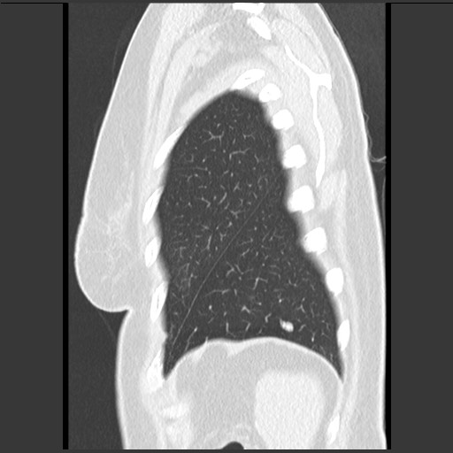 File:Amyloidosis - bronchial and diffuse nodular pulmonary involvement (Radiopaedia 60156-67744 F 50).jpg