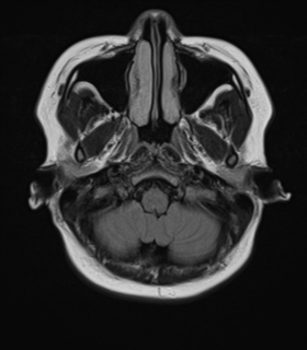 File:Anaplastic astroblastoma (Radiopaedia 55666-62194 Axial FLAIR 4).png