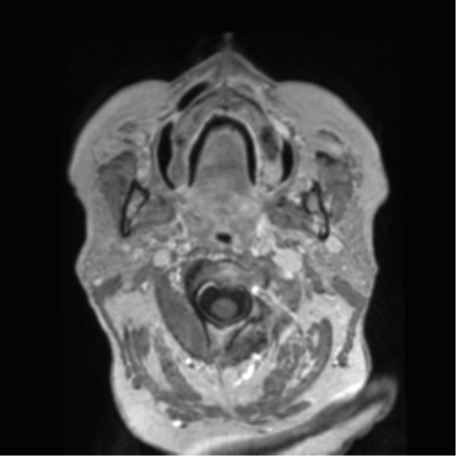 Anaplastic astrocytoma IDH wild-type (pseudoprogression) (Radiopaedia 42209-45278 Axial T1 C+ 4).png