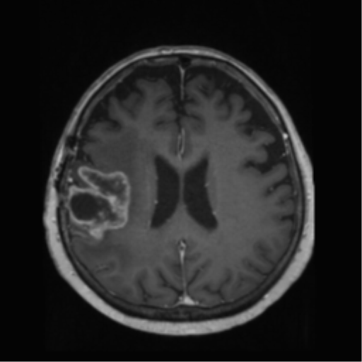 File:Anaplastic astrocytoma IDH wild-type (pseudoprogression) (Radiopaedia 42209-45278 Axial T1 C+ 99).png