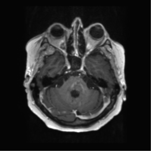 Anaplastic astrocytoma IDH wild-type (pseudoprogression) (Radiopaedia 42209-45279 Axial T1 C+ 43).png
