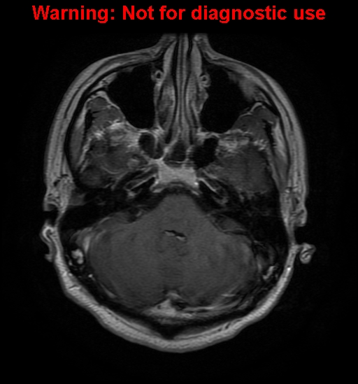 File:Anaplastic ganglioglioma (Radiopaedia 44921-48831 Axial T1 C+ 7).jpg