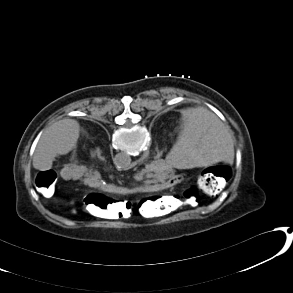 File:Anaplastic lymphoma - with CT biopsy (Radiopaedia 21643-21602 Axial non-contrast 10).jpg