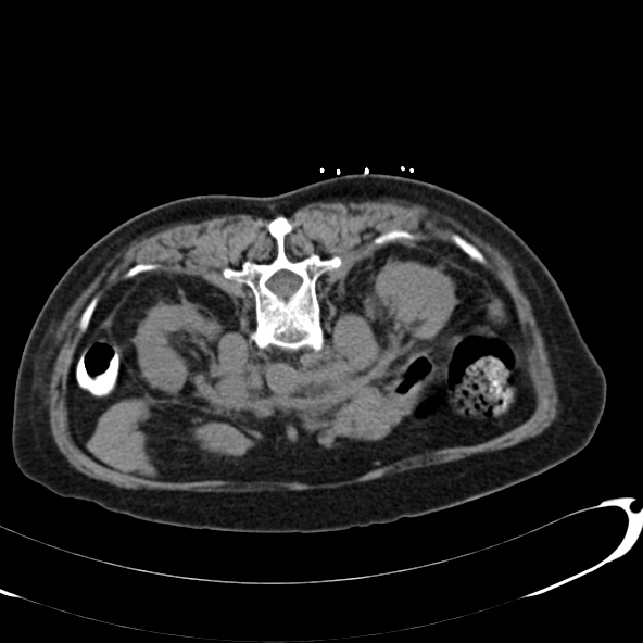 Anaplastic lymphoma - with CT biopsy (Radiopaedia 21643-21602 Axial non-contrast 25).jpg