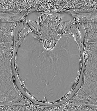Anaplastic oligodendroglioma (Radiopaedia 83500-98599 Axial SWI - phase 31).png