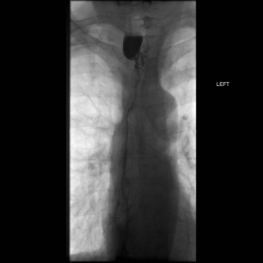 File:Anastomotic stricture post Ivor Lewis esophagectomy (Radiopaedia 47937-52715 B 27).png