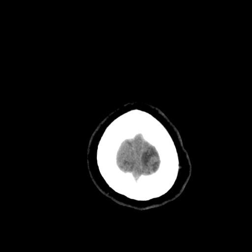 Aneursym related subarachnoid hemorrhage with hydrocephalus (Radiopaedia 45105-49085 Axial non-contrast 50).jpg